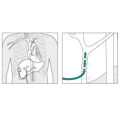 Placement of the Celsite® Arterial